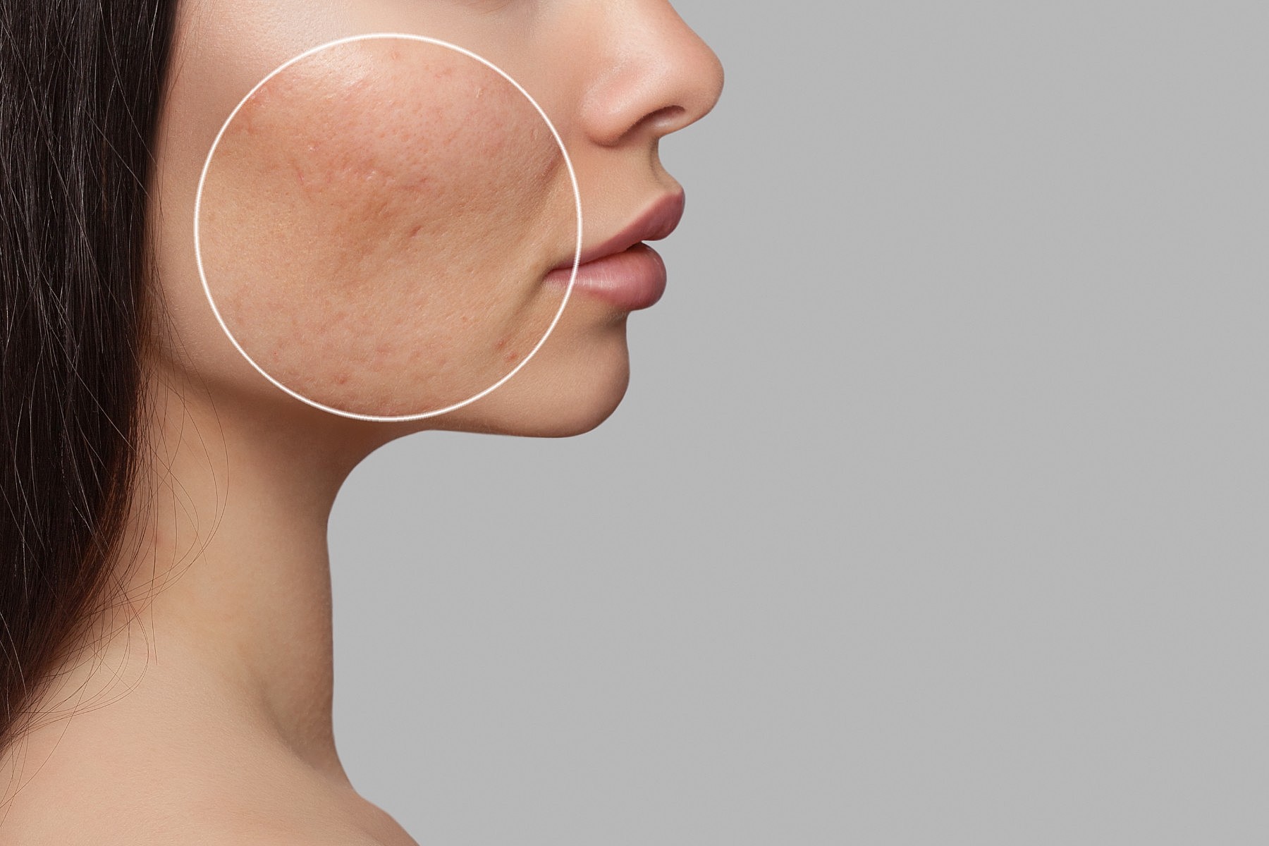 como evitar a dilatação dos poros