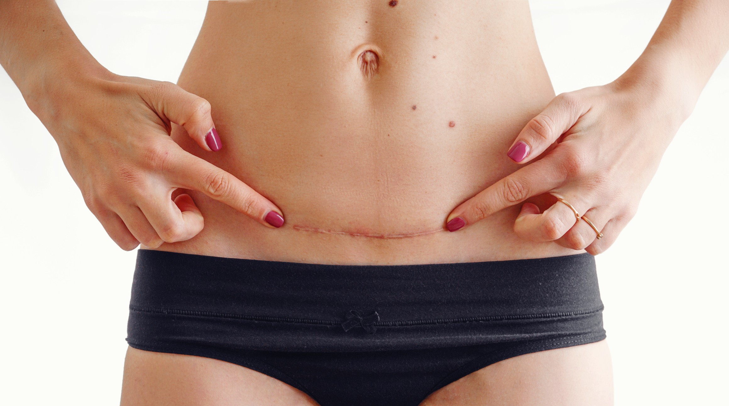 Cicatriz de cesárea: como cuidar e evitar estes 3 problemas - Minha Vida