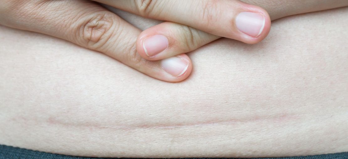 3 benefícios da fita de silicone para cicatriz de abdominoplastia