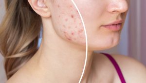 Cicatriz de acne: entenda como amenizar essas marcas