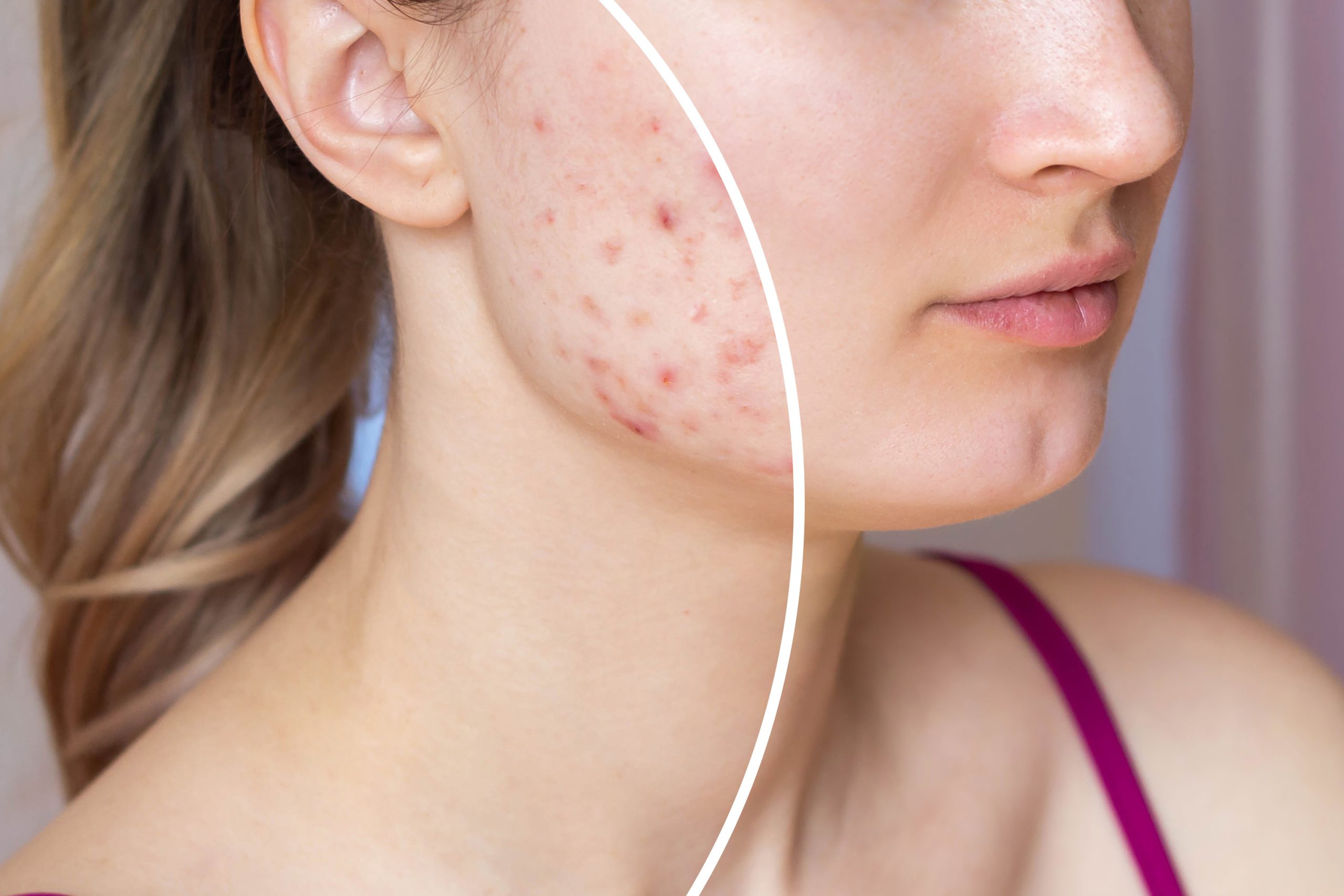 Cicatriz de acne entenda como amenizar essas marcas