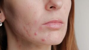 conheca-os-tipos-de-cicatrizes-de-acne-e-como-trata-las